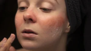 How to Get Rid of Dry Patches on Your Face Overnight?