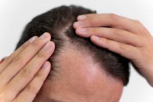 How to Regrow Hair Loss Due to Hard Water: Simple Solutions for Healthier Hair