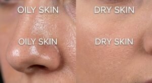 Side-by-side comparison of oily vs dry skin textures showing enlarged pores with shine and flaky matte skin.