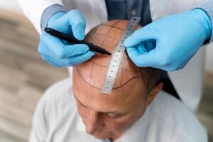 How Much Does Hair Transplant Cost in USA: Complete Guide 2025