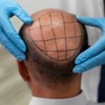 How Much Does Hair Transplant Cost in USA: Complete Guide 2025