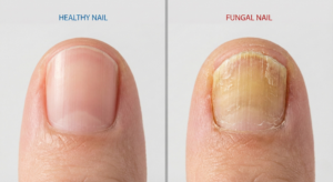 Healthy Nail,Fungal Nail