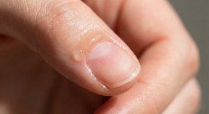Close up of an infected cuticle and painful hangnail caused by improper nail cutting.