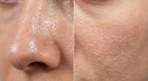 Comparison of oily skin and dry skin texture closeups.
