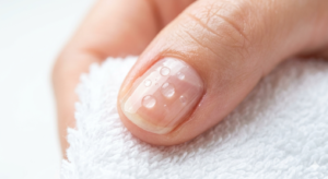 Macro shot of water droplets on a healthy fingernail, illustrating the importance of drying nails to prevent brittle nails.